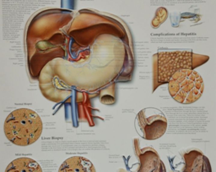 Kepenų vėžio rizikos faktoriai sergant virusiniu hepatitu B 