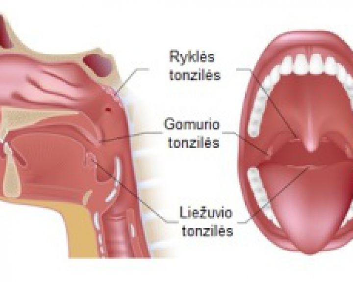Gumulėlis gerklėje. Dėl kokių priežasčių formuojasi?