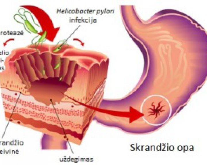 Nėščiųjų vėmimo atveju - Helicobacter pylori testas