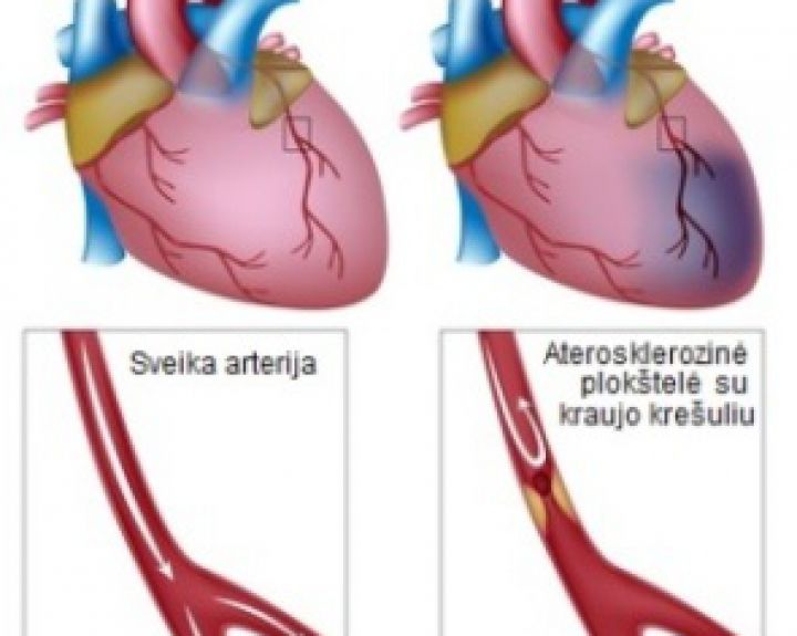 Širdies kraujagyslių stentavimui, trombolizėms bei trombektomijoms - prioritetinis finansavimas