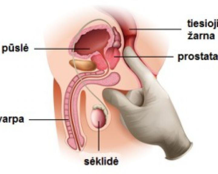 Gajus prostatos vėžio mitas - nieko nejaučiu, vadinasi, esu sveikas