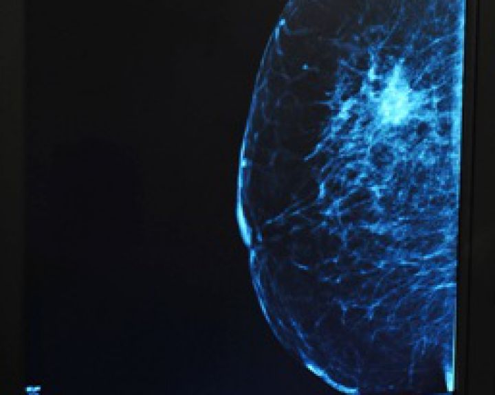 Pasaulinė krūties diena: pasitikrinkime dėl krūties vėžio