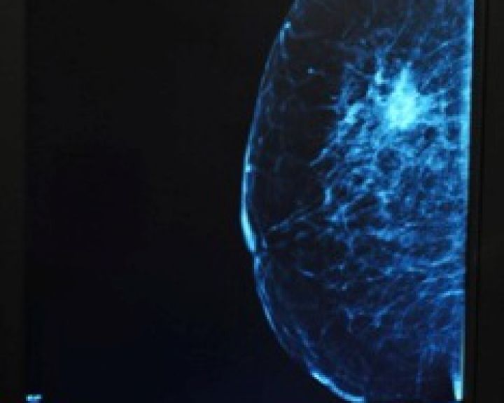 Du žymenys parodo blogą krūties vėžio prognozę 