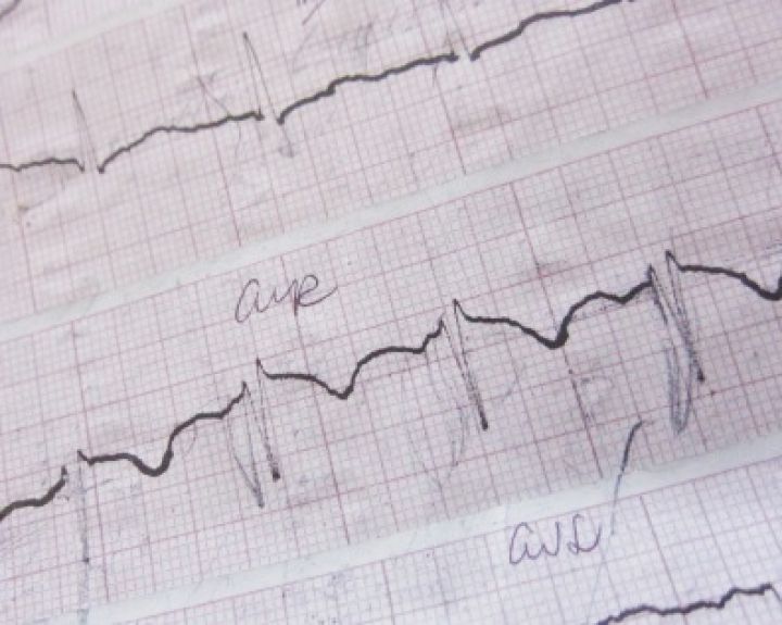 Išmaniosios technologijos diagnozuos širdies aritmijos vystymosi pradžią