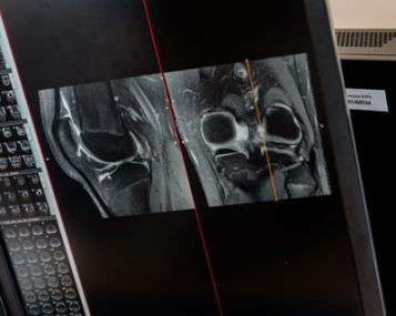 Disekuojantis osteochondritas: ką reiškia sugrįžęs skausmas?