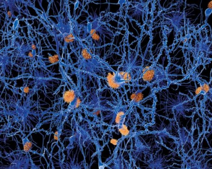 Alzheimerio ligą bandys gydyti žemo dažnio garsais