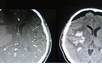 Naujovė: kovai su hemoraginiu insultu pasitelkė stereotaksinį metodą