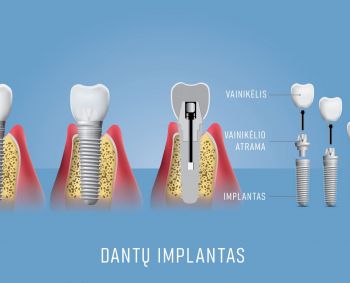 Dantų implantavimas Vilniuje: dantų praradimas šiandien – ne pabaiga