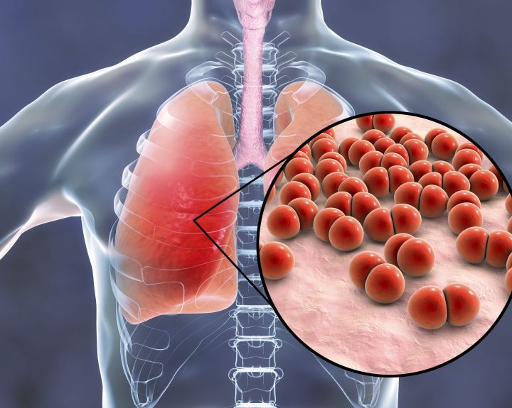 Nerimą kelia ne tik COVID-19: kiekvieną žiemą siaučia ir pneumokokas