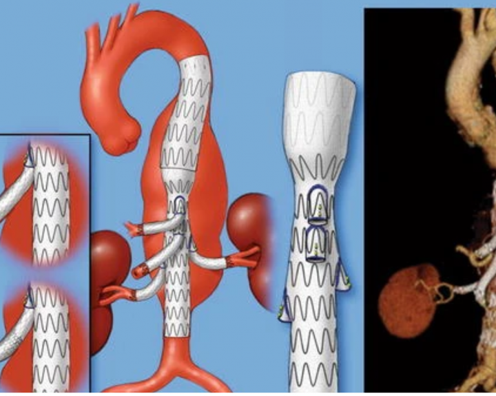 Стент графт аорты операция. Стент графт коронарный.