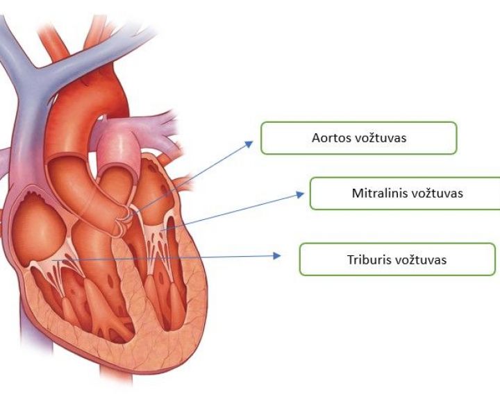 Aortos vožtuvo stenozė: komplikacijos gali negrįžtamai pakeisti gyvenimą