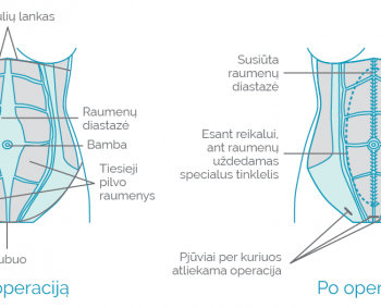 Pilvo sienos išvaržos: mažas gumbelis gali lemti nemalonias bėdas