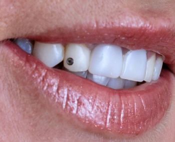 Vietoj baltos šypsenos - margi dantys