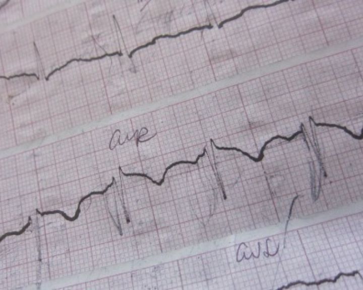 Jaučiu ekstrasistoles. Ką daryti?