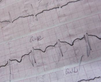 Jaučiu ekstrasistoles. Ką daryti?
